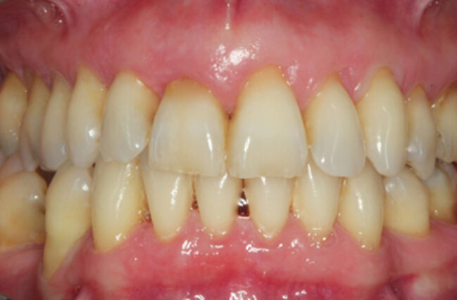 Gum Disease Treatment