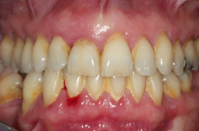 Gum Disease Treatment