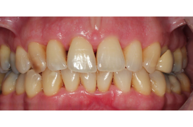 Non-surgical Periodontal Therapy