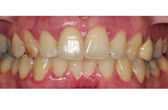 Non-surgical Periodontal Therapy