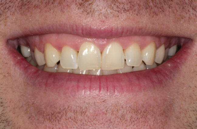Cosmetic Gum Lift - Before
