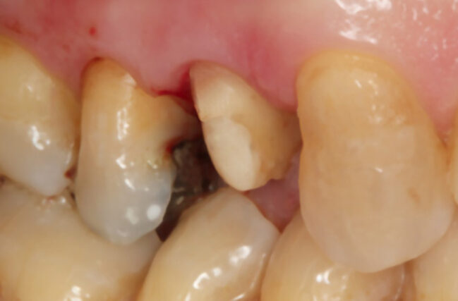 Crown Lengthening in Bolton