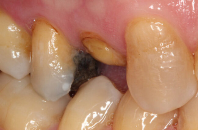 Crown Lengthening in Bolton