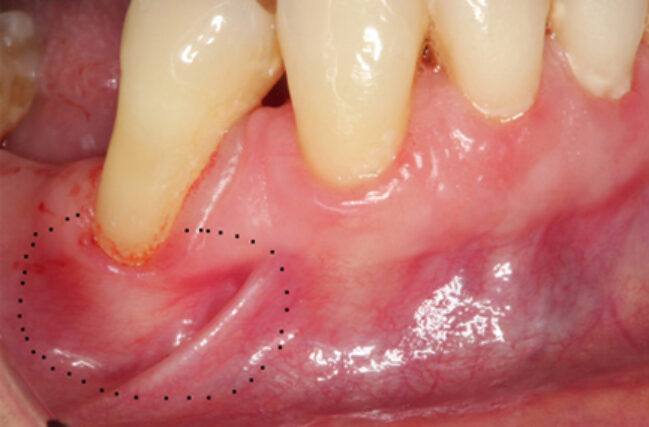 Gum Recession Treatment