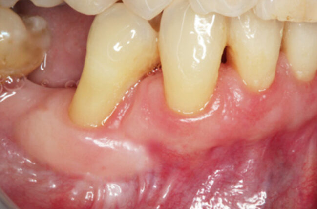 Gum Recession Treatment